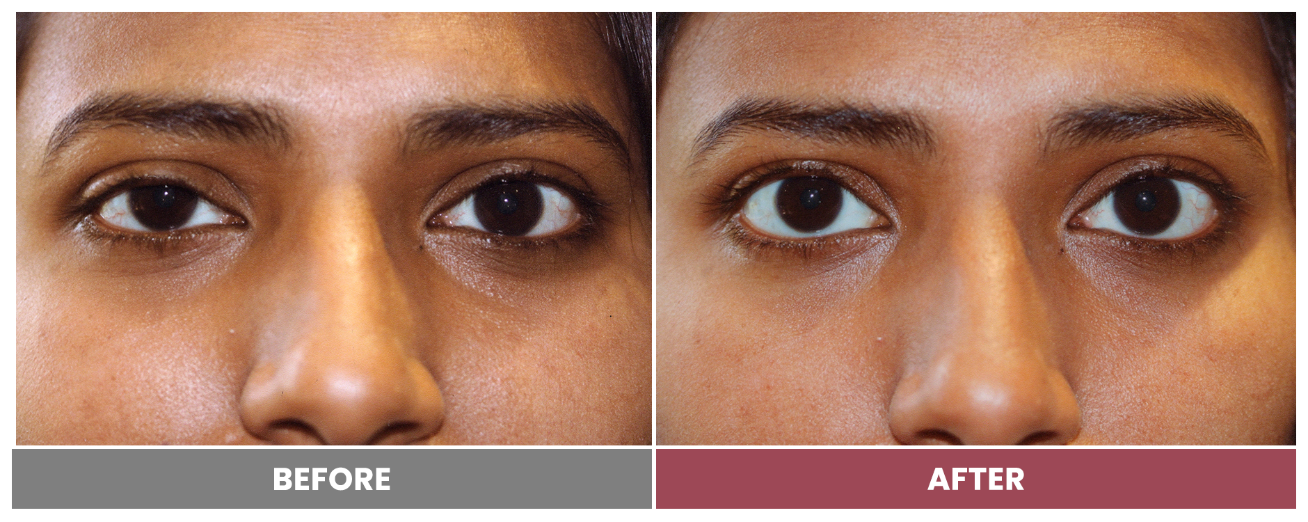 PTOSIS REPAIR - Case 24